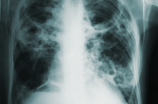 肺部结节需要治疗吗？如何治疗肺部结节？